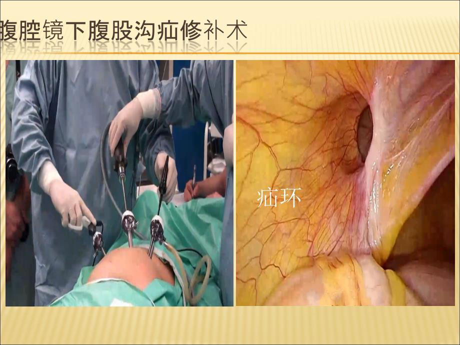 腹股沟疝腹腔镜解剖要点及手术步骤.ppt_第3页