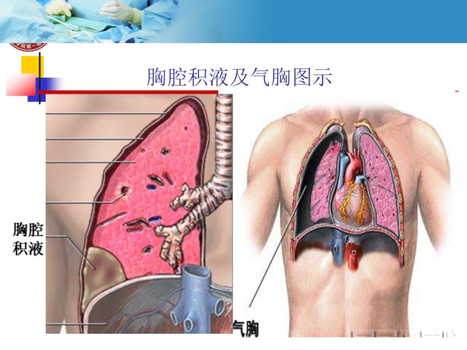 胸腔穿刺技能操作.ppt_第3页