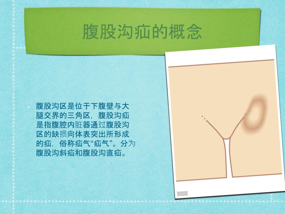 腹股沟疝围手术期护理ppt课件.pptx_第3页
