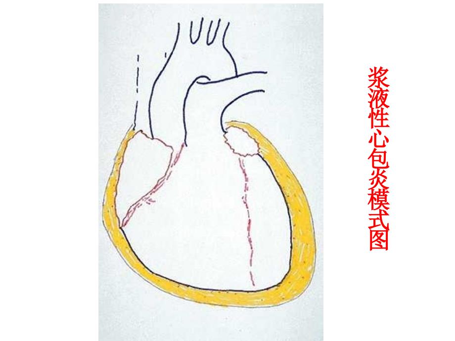 第8版内科学心包积液及心脏压塞课件.ppt_第3页