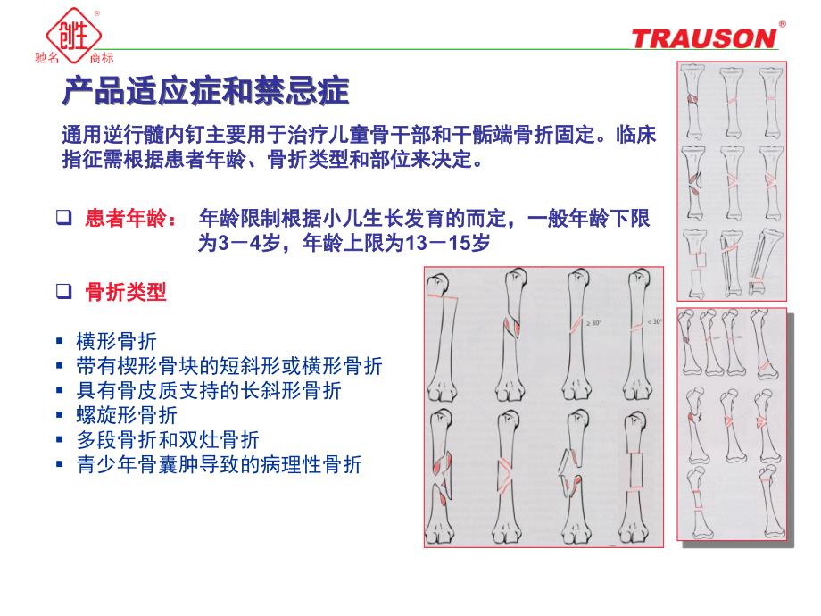 通用逆行髓内钉小儿弹性髓内钉.ppt.ppt_第3页