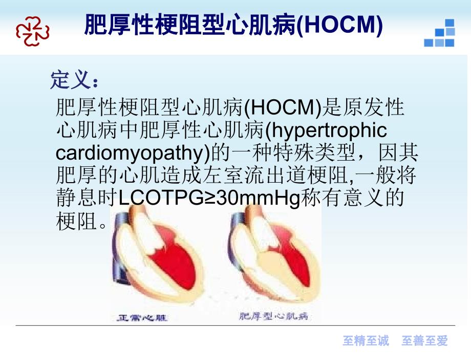 肥厚梗阻型心肌病PPT课件.pptx_第3页