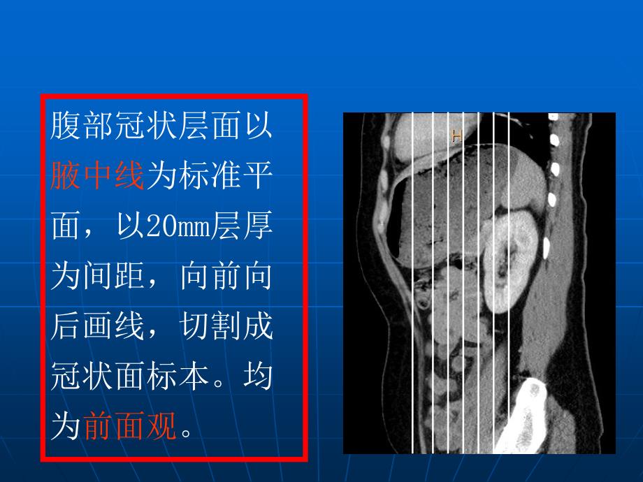 腹部断层解剖第四节腹部冠状断层解剖.ppt_第2页