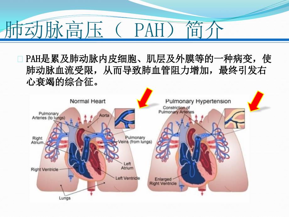 肺动脉高压查房.ppt_第2页