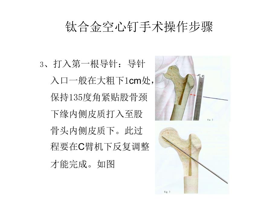 钛合金空心钉手术操作步骤.ppt_第2页