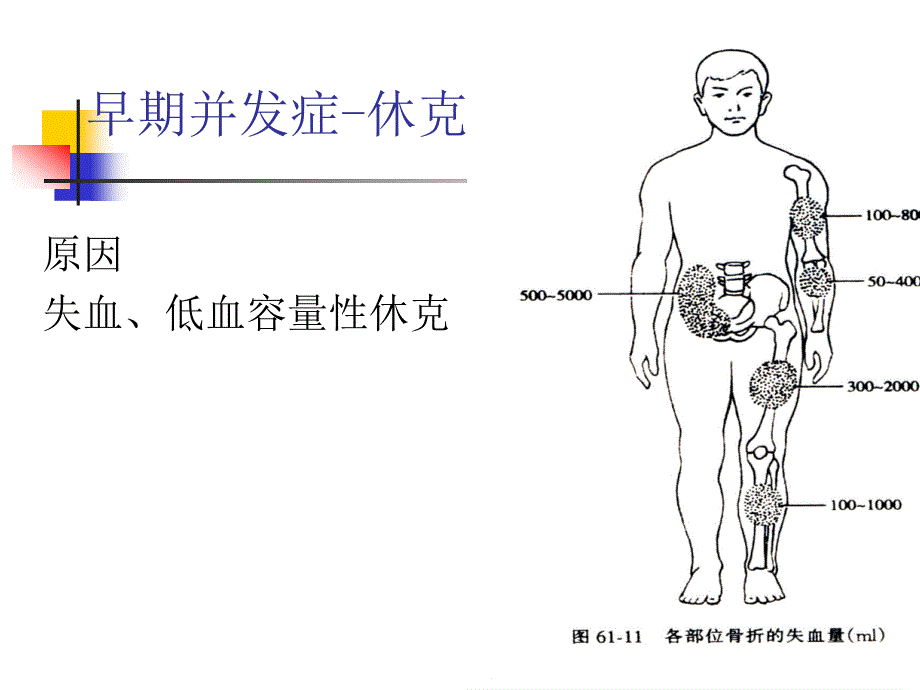 骨折并发症的护理PPT课件.ppt_第2页