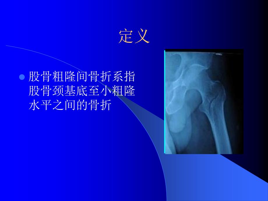 股骨粗隆间骨折PPT课件.ppt_第2页