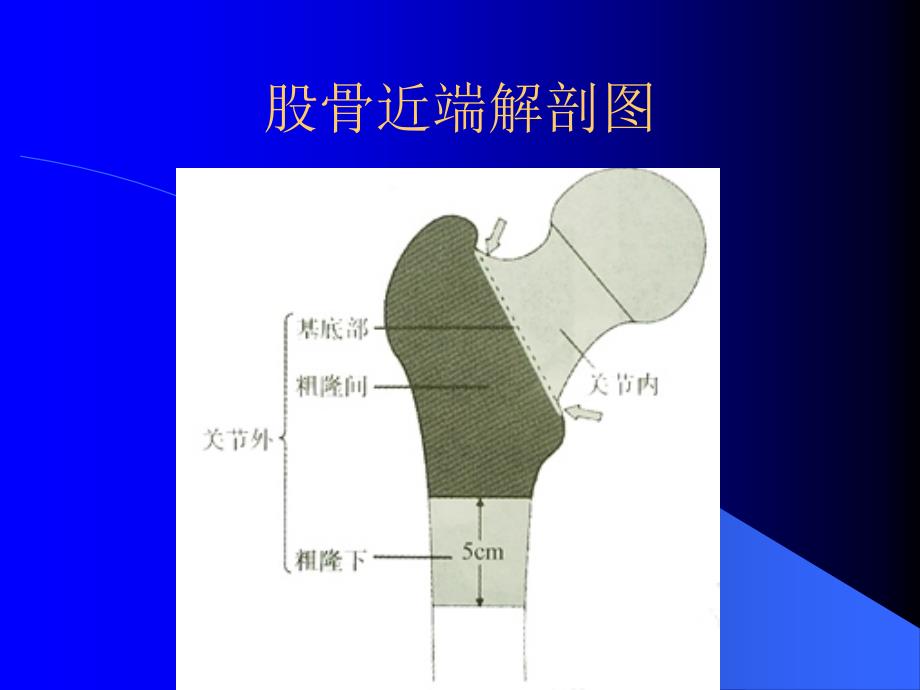 股骨粗隆间骨折PPT课件.ppt_第3页