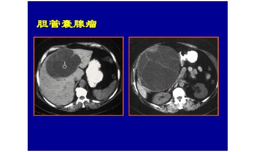 肝脏囊性占位灶ppt课件.pptx_第3页