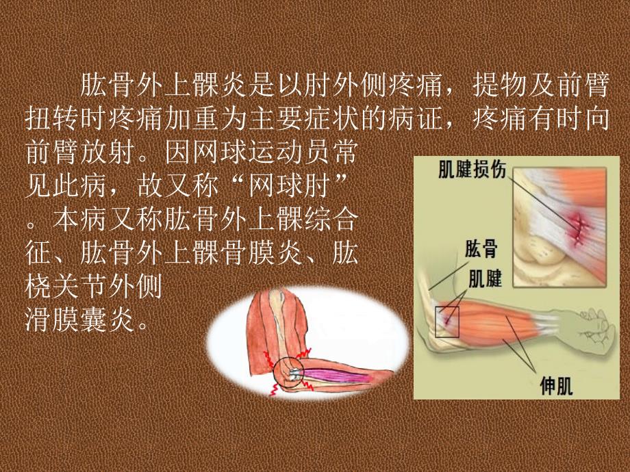 肱骨外上髁炎PPT课件.ppt_第2页
