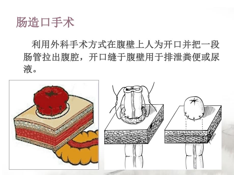 造口术前定位ppt课件.ppt_第2页