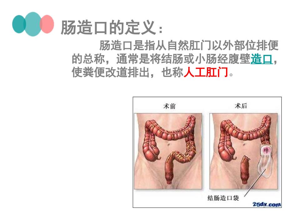 造瘘口的护理PPT课件.ppt_第2页