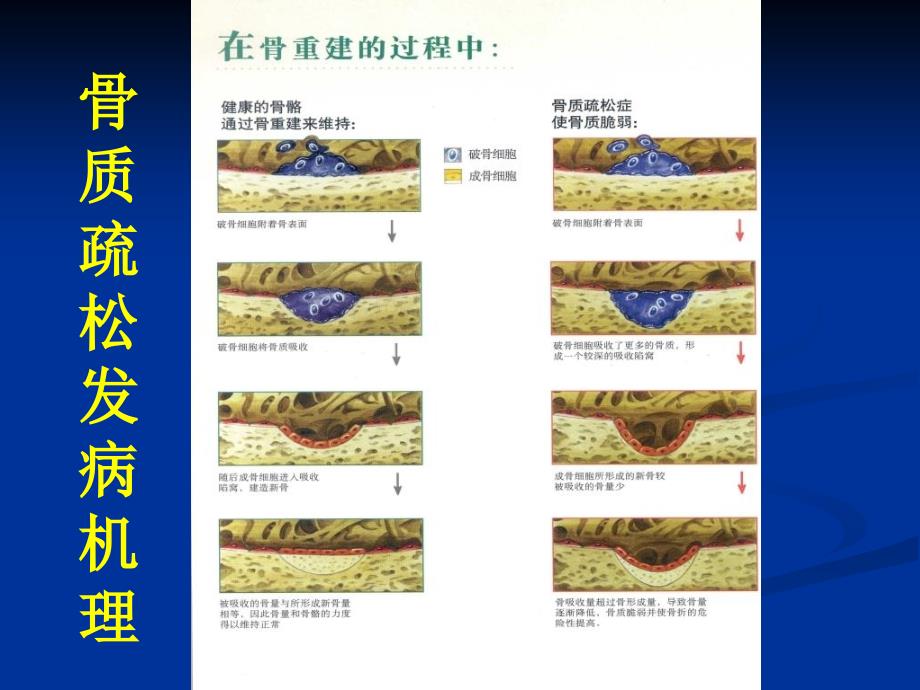骨质疏松的危害PPT课件.ppt_第3页