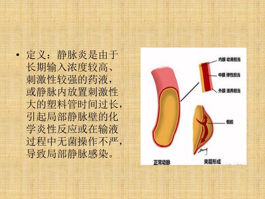 静脉炎的分级及处理.ppt_第3页