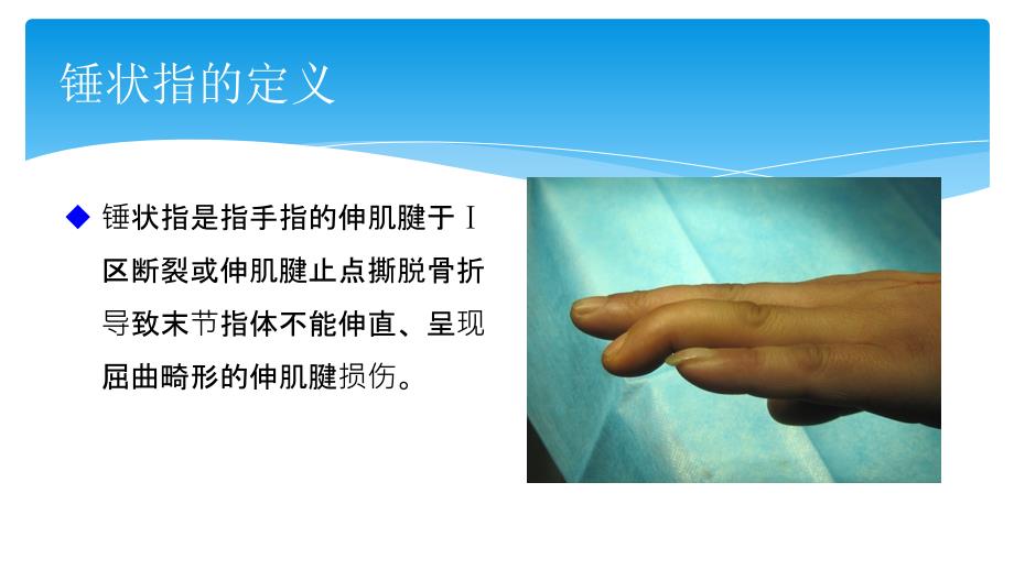 锤状指治疗进展及探索.ppt_第2页