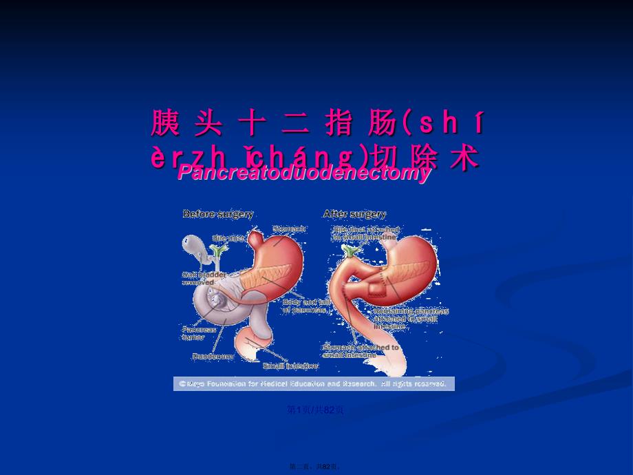 胰腺外科常用手术术式学习教案.pptx_第2页