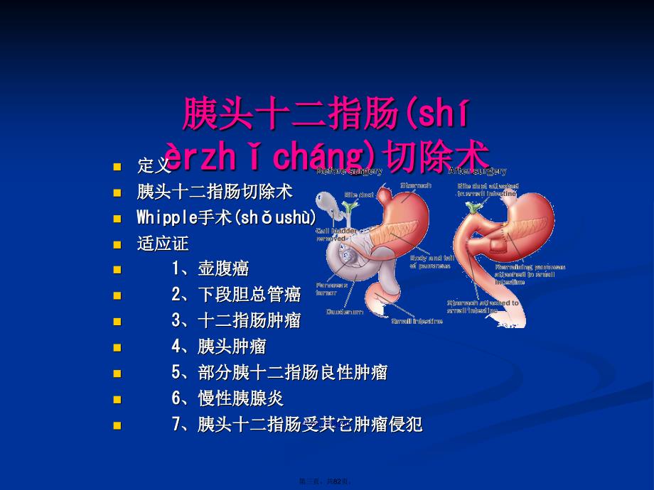胰腺外科常用手术术式学习教案.pptx_第3页