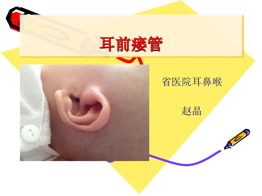 耳前瘘管.ppt_第1页