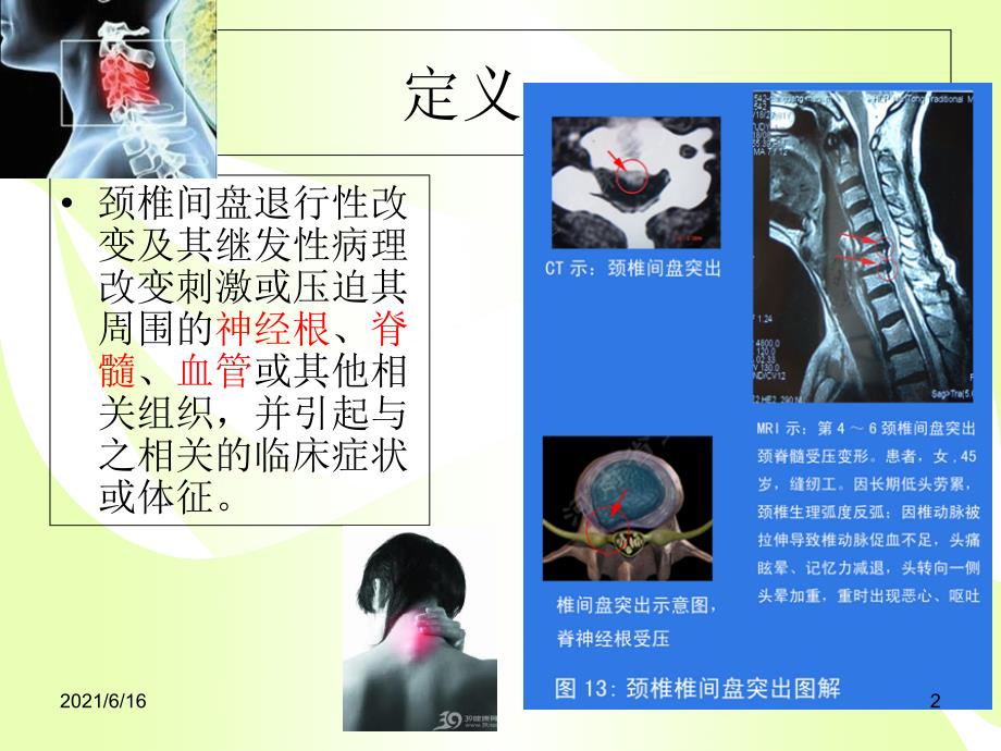 颈椎病的健康教育.ppt.ppt_第2页