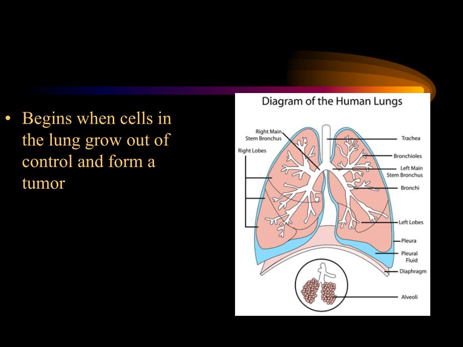 讲课肺癌英文PPT课件.ppt_第2页
