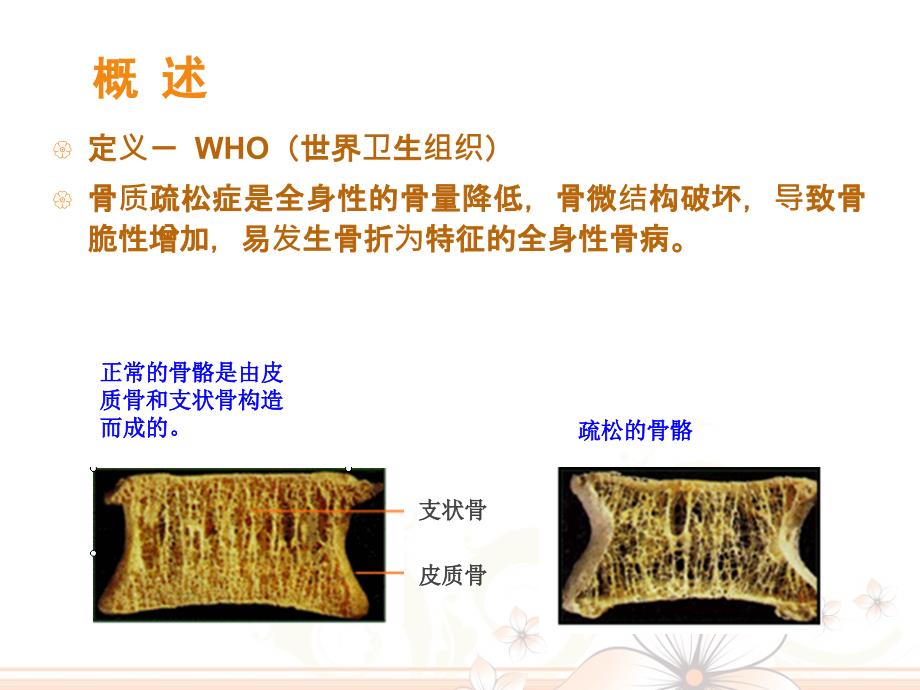老骨质疏松症的护理.ppt_第2页