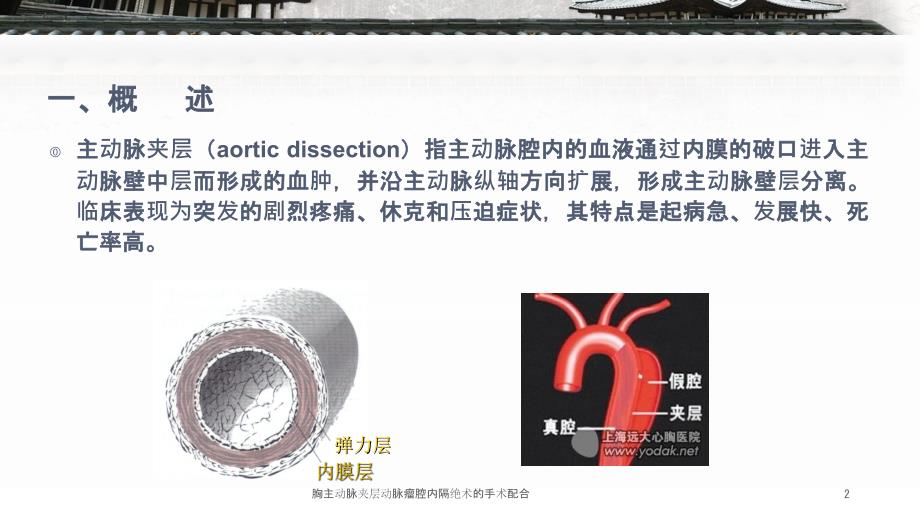 胸主动脉夹层动脉瘤腔内隔绝术的手术配合ppt课件.ppt_第2页