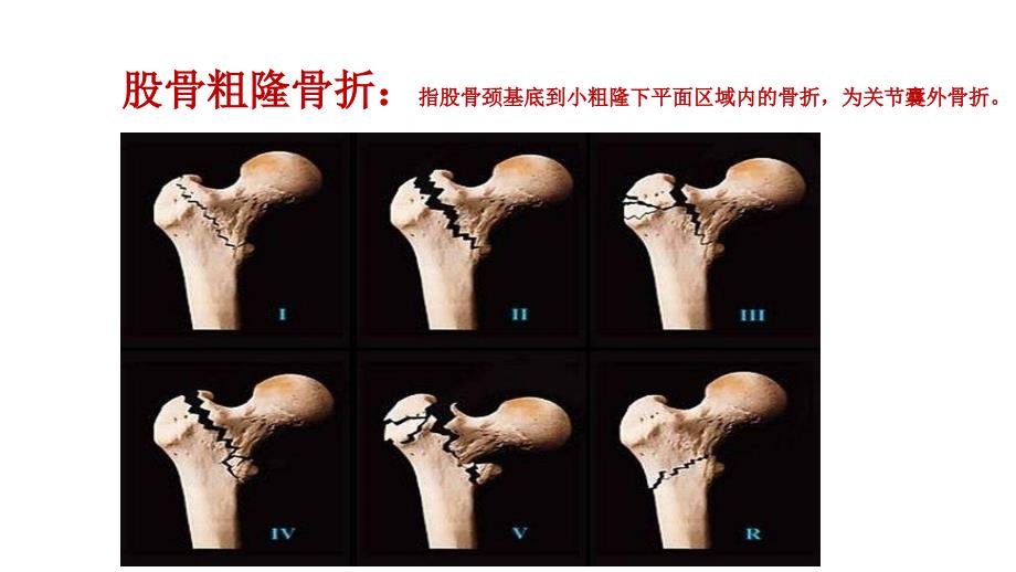 股骨粗隆骨折中医护理方案.ppt_第2页