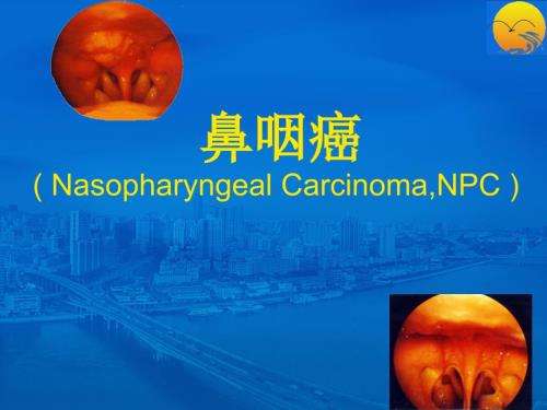 鼻咽癌PPT课件.ppt