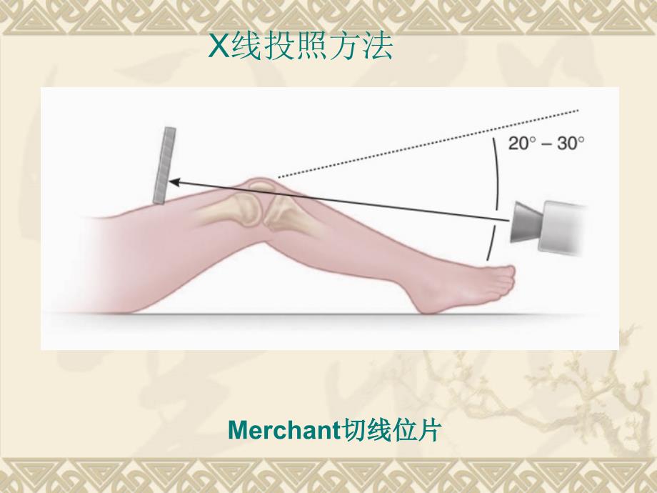髌骨脱位精讲版.ppt_第3页