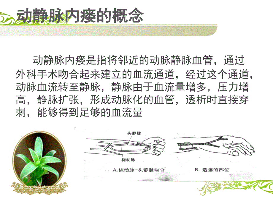 血液透析患者动静脉内瘘的护理PPt.ppt_第2页