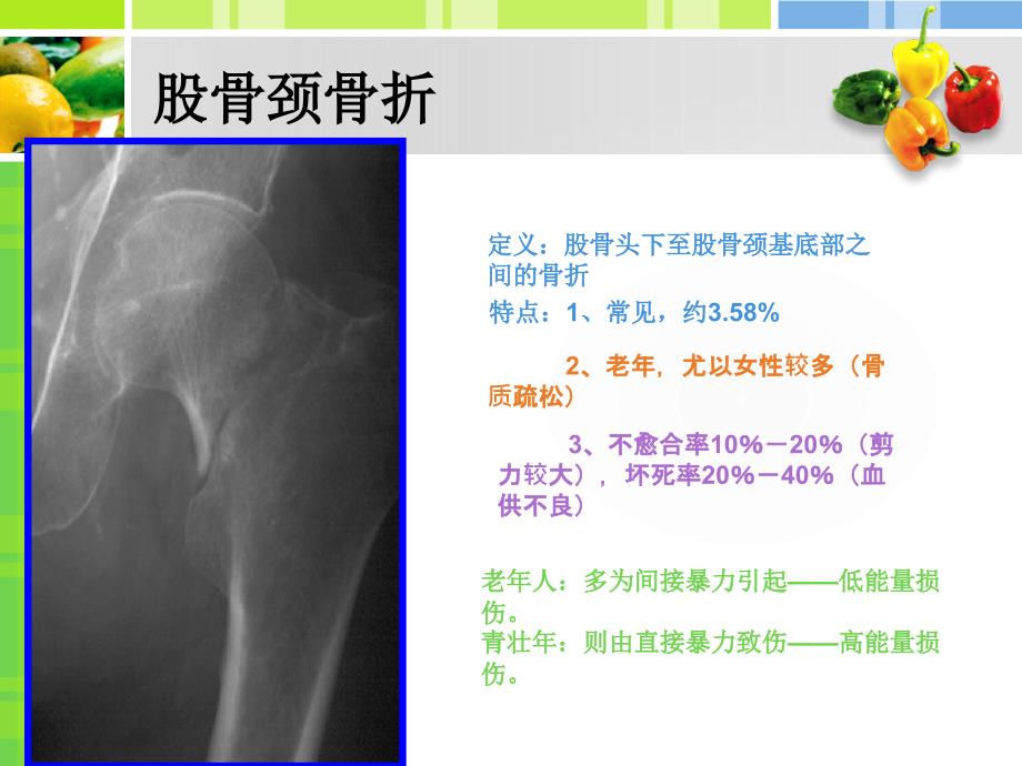 股骨颈骨折PPT课件.ppt_第3页