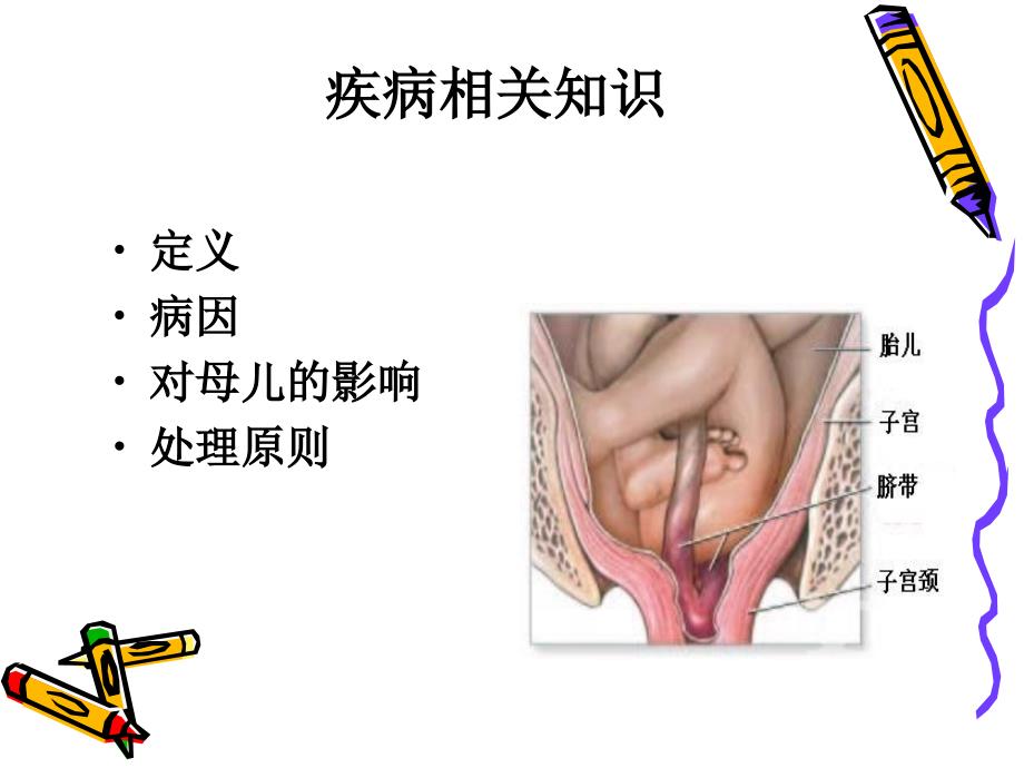 脐带脱垂护理查房PPT.ppt_第3页