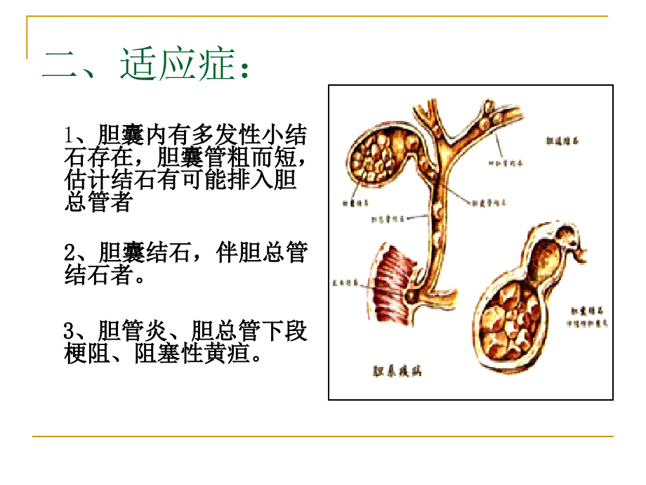 胆囊切除术胆总管切开取石术.ppt_第3页