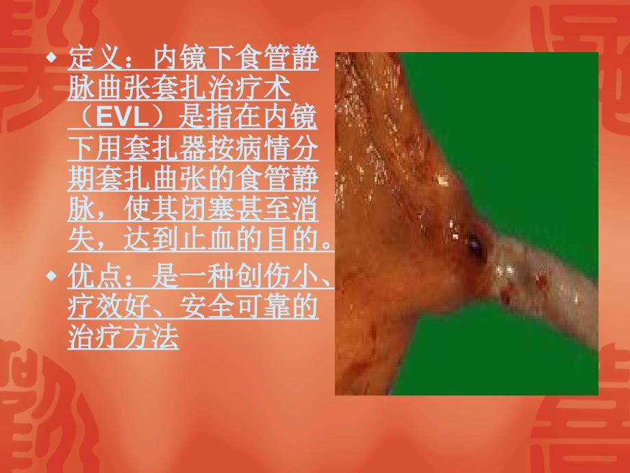 食管胃底静脉曲张护理课件.ppt_第2页
