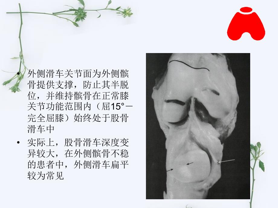 髌骨脱位课件.ppt_第3页