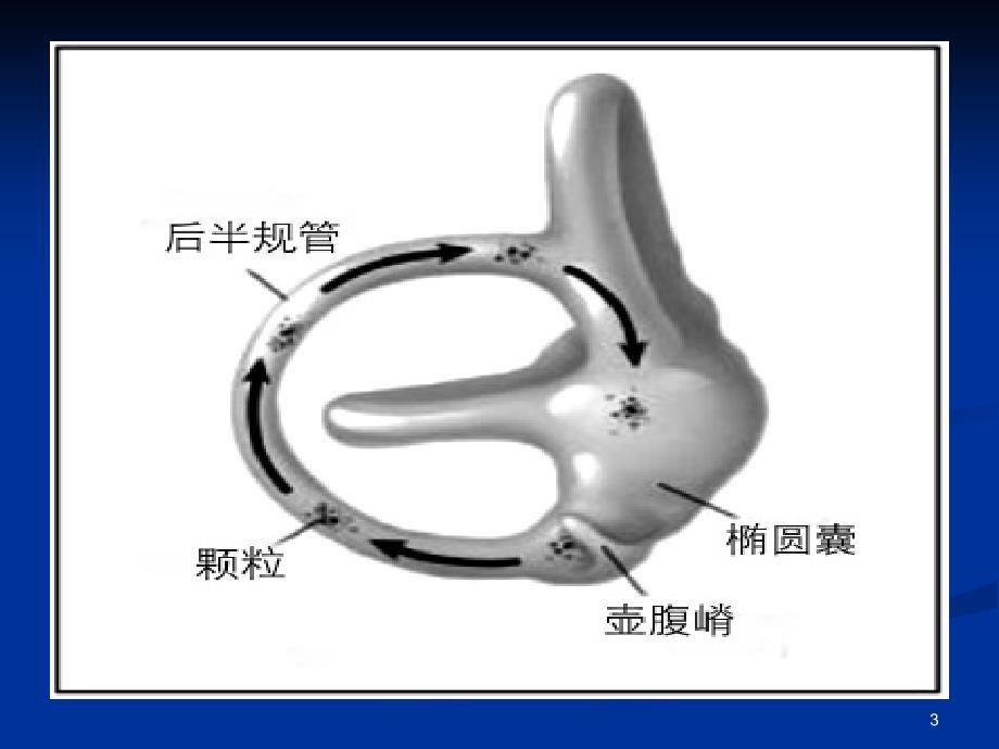 耳石症ppt课件.ppt_第3页