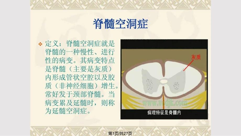 脊髓空洞症病人的护理图文PPT课件.pptx_第1页
