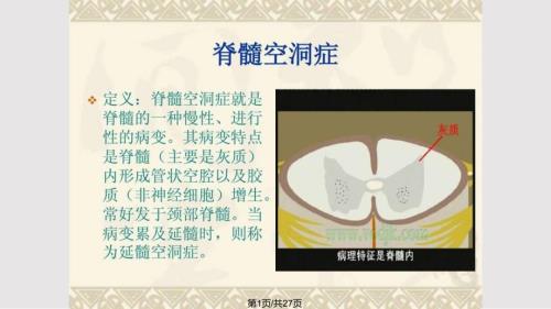 脊髓空洞症病人的护理图文PPT课件.pptx