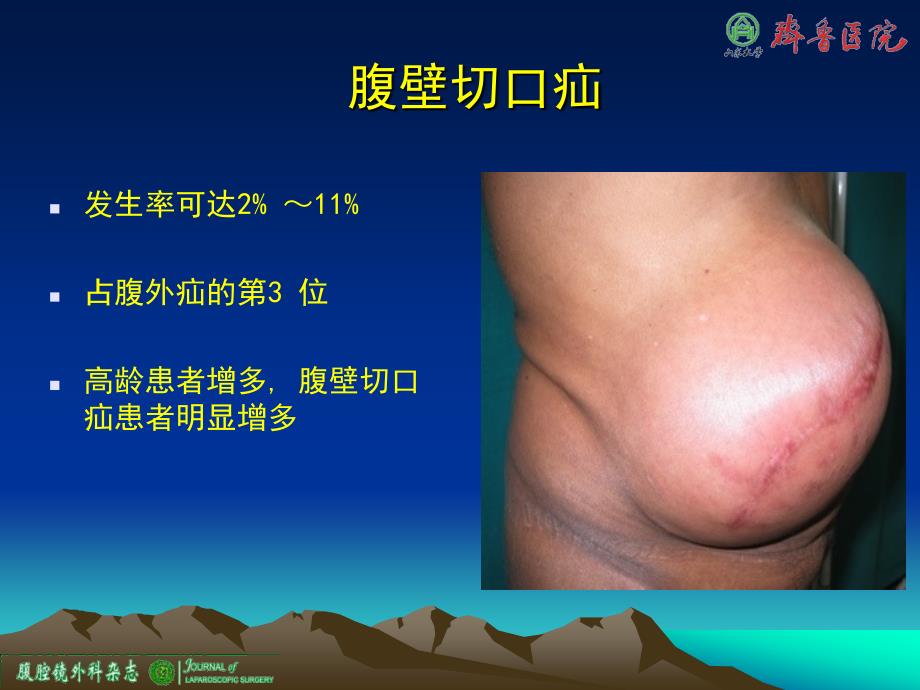 腹腔镜腹壁切口疝修补术.ppt_第1页