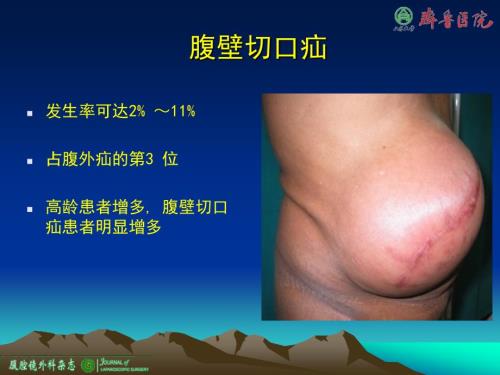 腹腔镜腹壁切口疝修补术.ppt