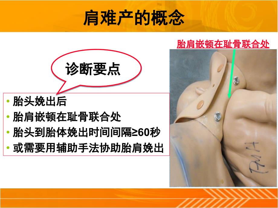 肩难产的处理PPT课件.ppt_第3页