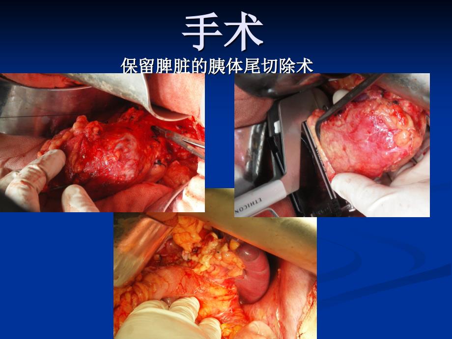 胰腺囊性肿瘤诊治PPT课件.pptx_第1页
