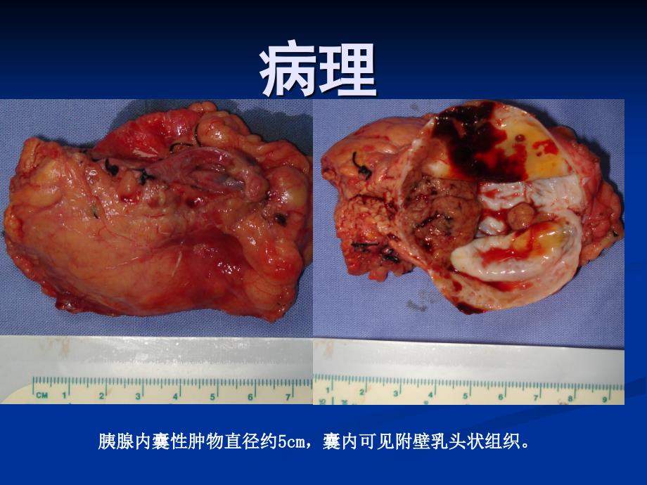 胰腺囊性肿瘤诊治PPT课件.pptx_第2页
