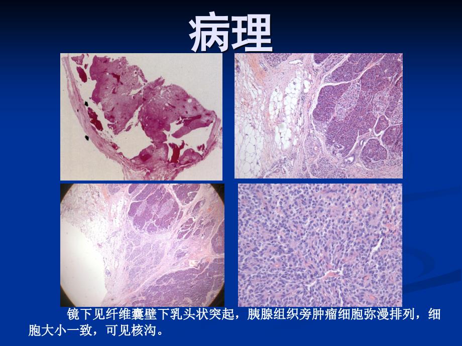 胰腺囊性肿瘤诊治PPT课件.pptx_第3页