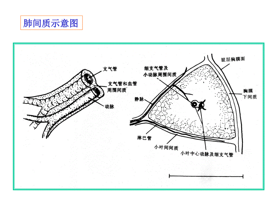 肺间质性病变图片PPT课件.ppt_第2页