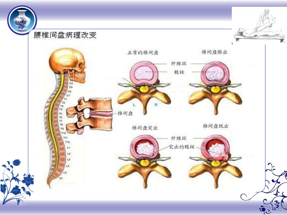 腰椎间盘突出症的中医护理课件.ppt_第3页