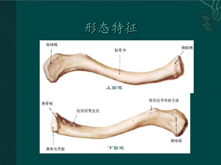锁骨远端骨折.ppt_第3页