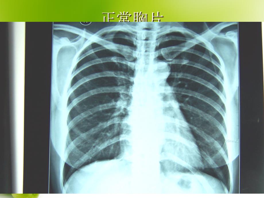 肺部常见病X线诊断ppt课件.ppt_第3页