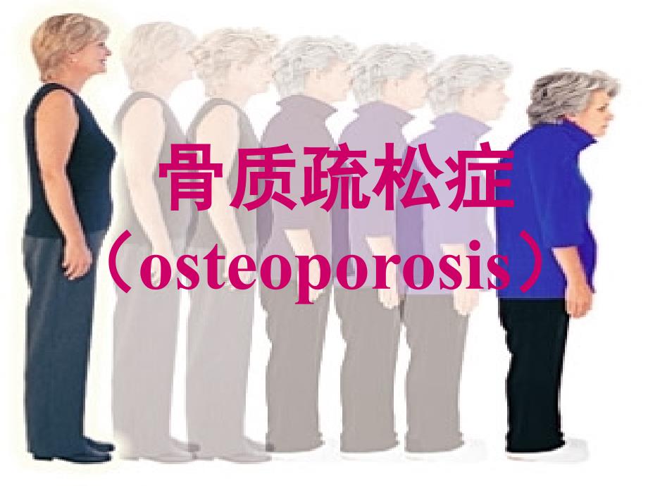 骨质疏松骨质疏松症.ppt_第1页