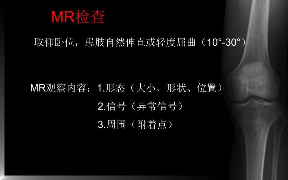 膝关节MRI课件.ppt_第2页